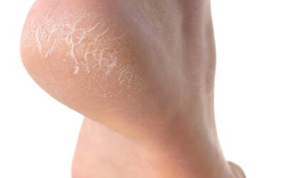 Hvorfor opstår der hård hud på fødderne?